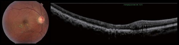 網膜静脈分岐閉塞症 眼底カメラ撮影画像